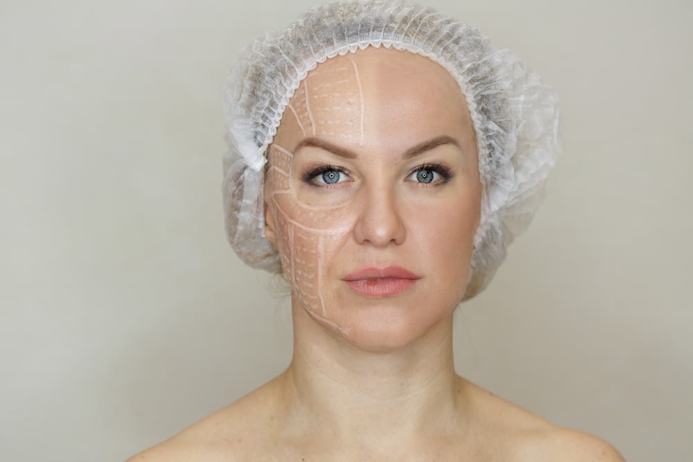 What is a Non-Surgical Face Lift?